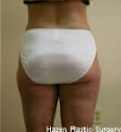 Female Liposuction Before & After Gallery - Patient 9605563 - Image 6