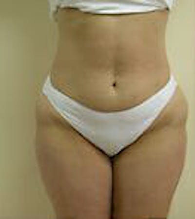 Female Liposuction Gallery - Patient 9605571 - Image 1