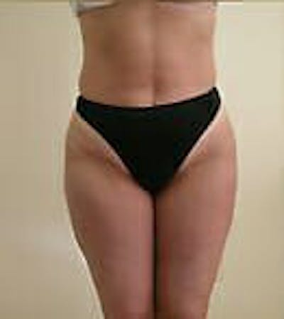 Female Liposuction Before & After Gallery - Patient 9605571 - Image 2
