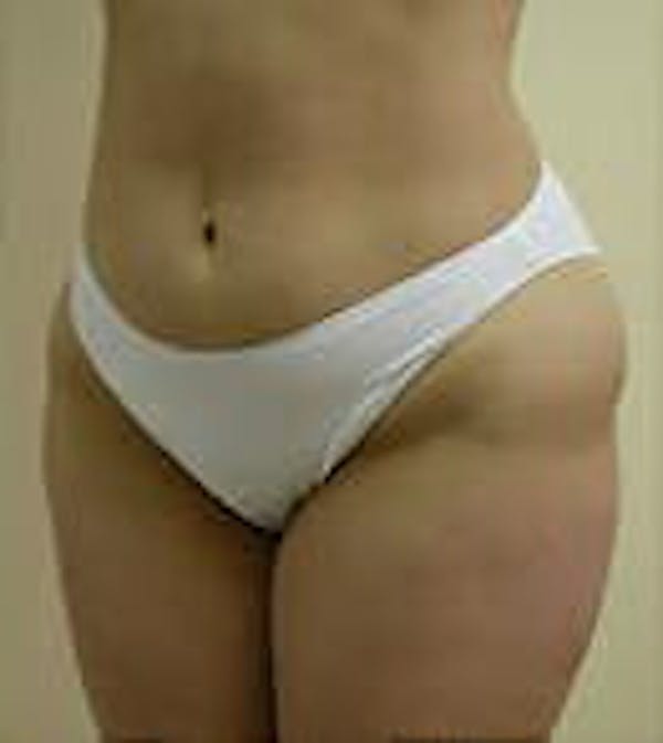 Female Liposuction Before & After Gallery - Patient 9605571 - Image 3