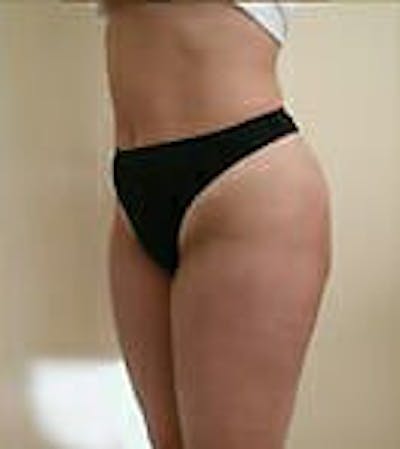 Female Liposuction Gallery - Patient 9605571 - Image 4