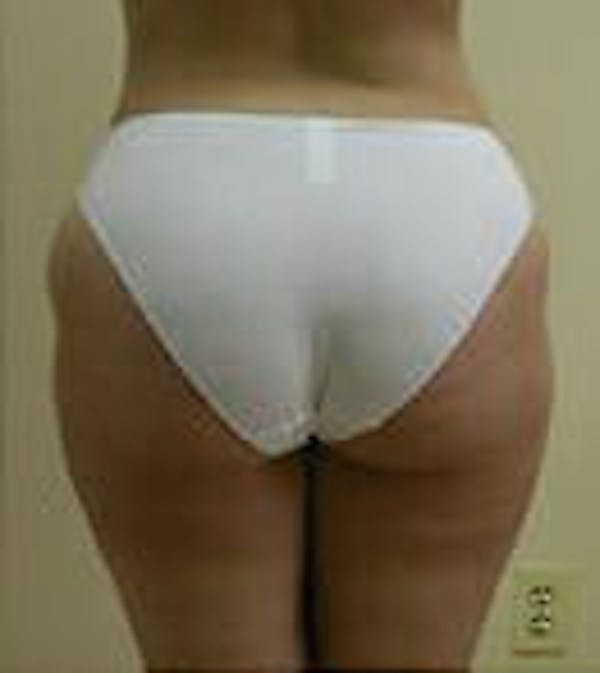 Female Liposuction Gallery - Patient 9605571 - Image 5