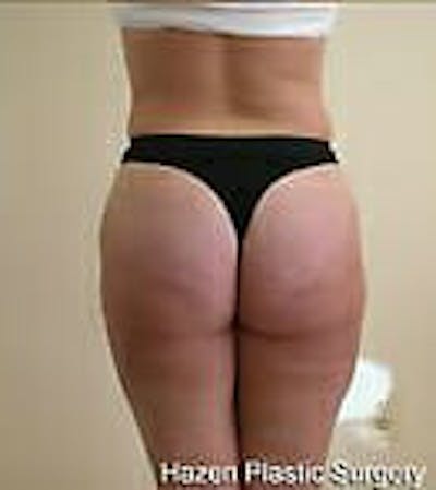 Female Liposuction Before & After Gallery - Patient 9605571 - Image 6