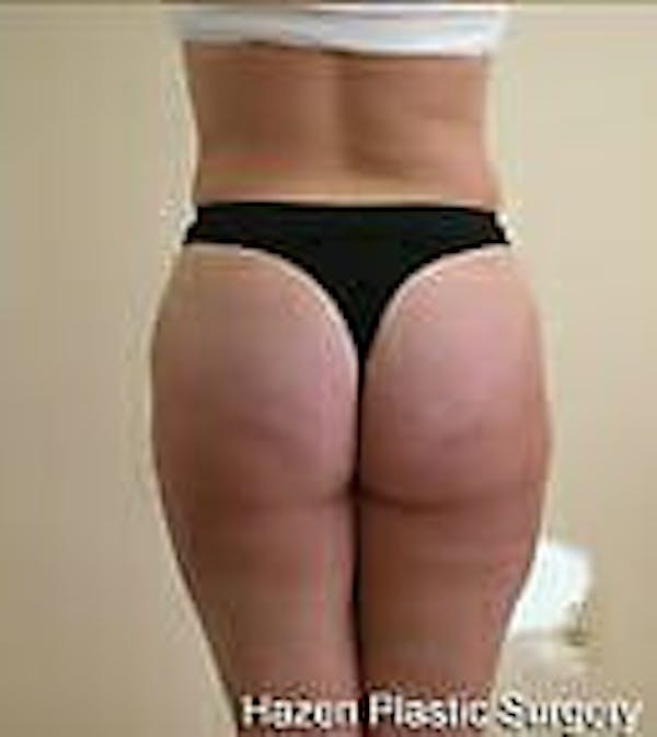 Female Liposuction Gallery - Patient 9605571 - Image 6