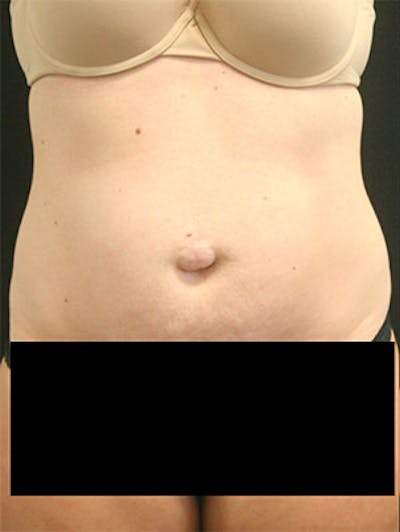 Tummy Tuck Before & After Gallery - Patient 9605573 - Image 1