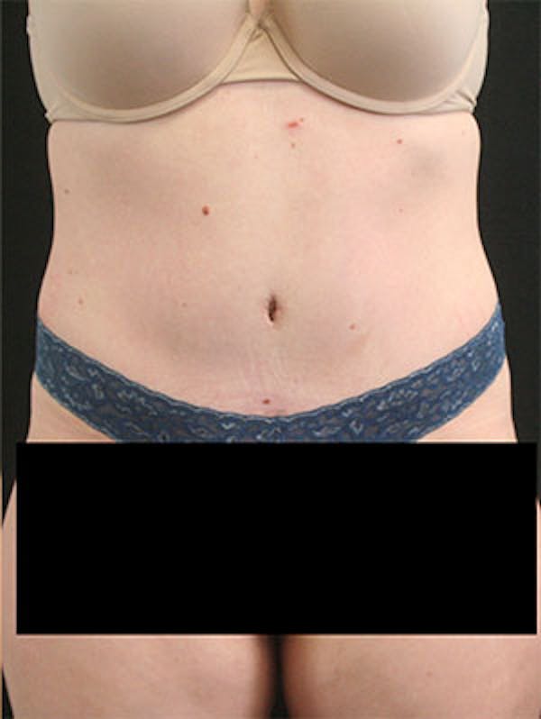 Tummy Tuck Before & After Gallery - Patient 9605573 - Image 2