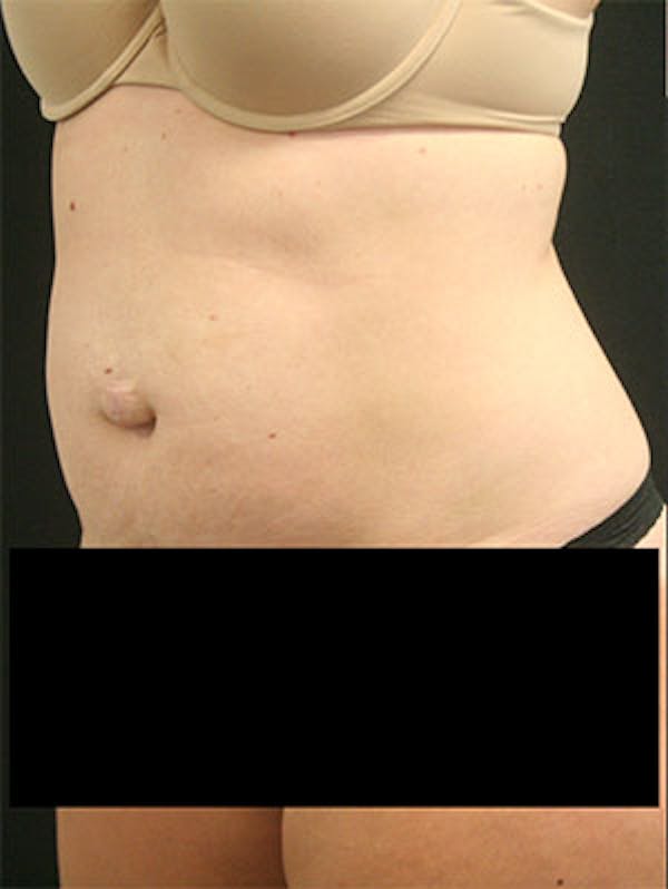 Tummy Tuck Before & After Gallery - Patient 9605573 - Image 3