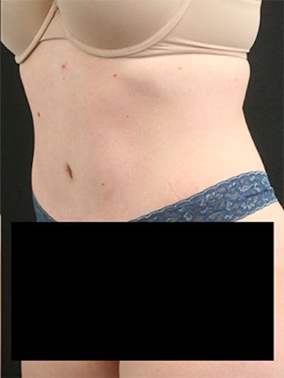 Tummy Tuck Before & After Gallery - Patient 9605573 - Image 4