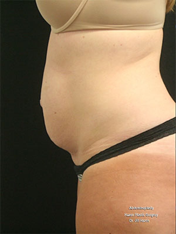 Tummy Tuck Before & After Gallery - Patient 9605573 - Image 5