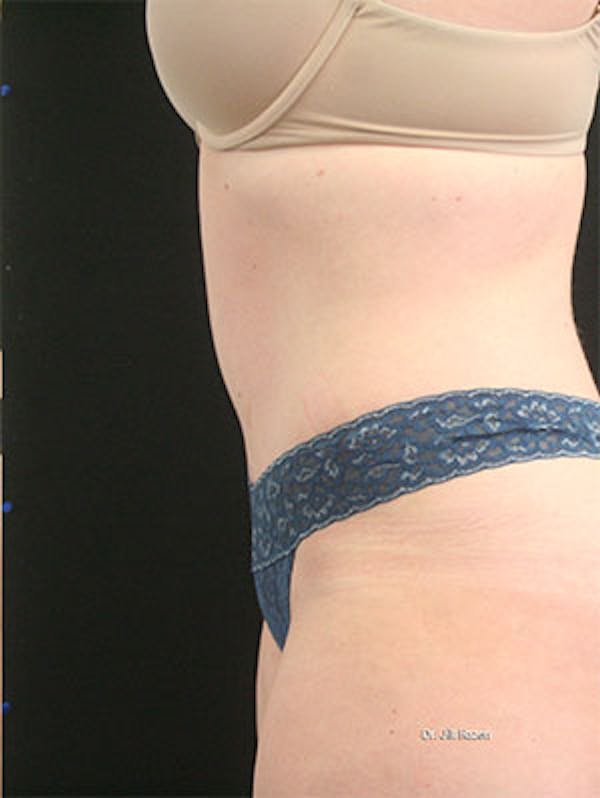 Tummy Tuck Before & After Gallery - Patient 9605573 - Image 6