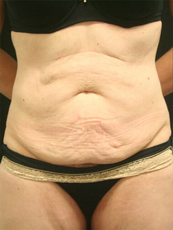 Tummy Tuck Before & After Gallery - Patient 9605576 - Image 1