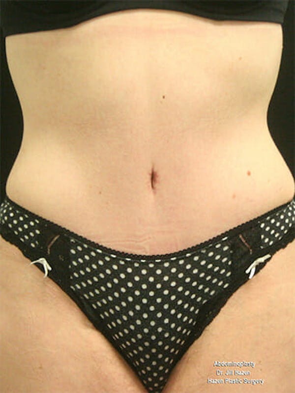 Tummy Tuck Gallery - Patient 9605576 - Image 2