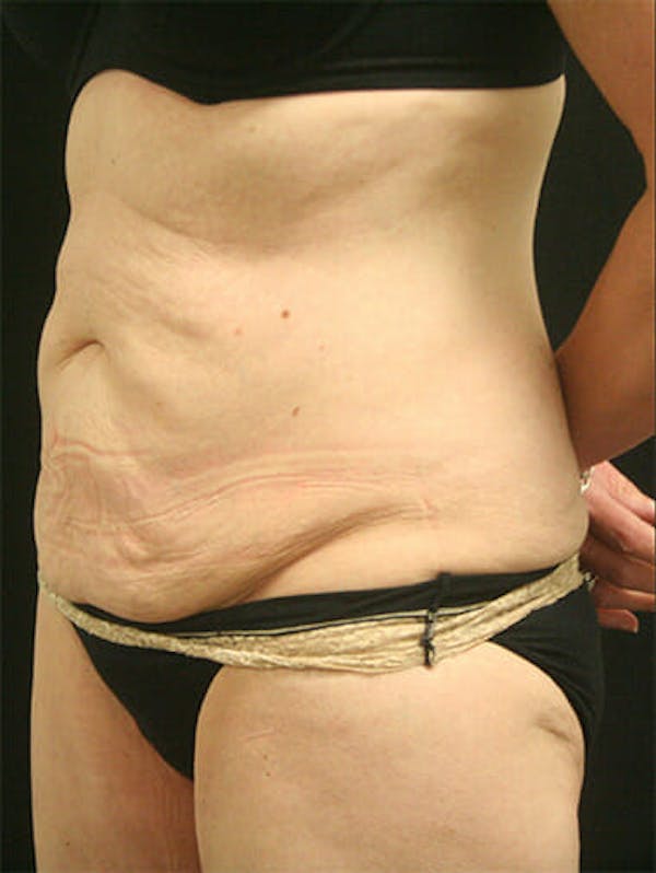 Tummy Tuck Before & After Gallery - Patient 9605576 - Image 3