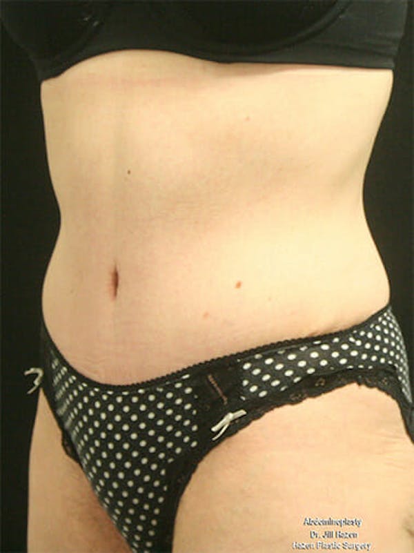 Tummy Tuck Before & After Gallery - Patient 9605576 - Image 4
