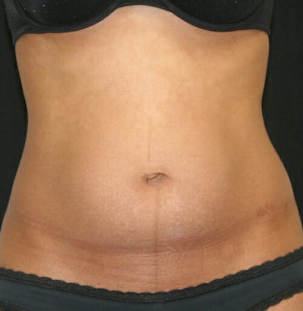 Tummy Tuck Before & After Gallery - Patient 9605578 - Image 1