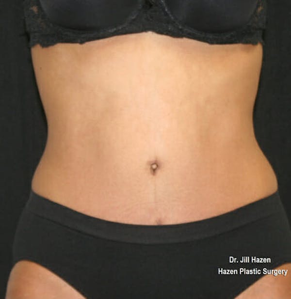 Tummy Tuck Before & After Gallery - Patient 9605578 - Image 2