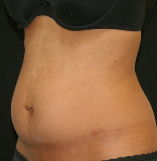 Tummy Tuck Before & After Gallery - Patient 9605578 - Image 3