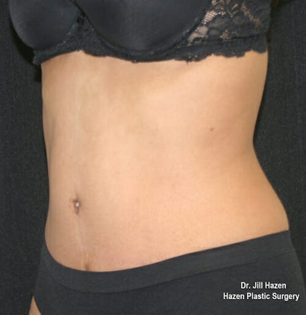 Tummy Tuck Before & After Gallery - Patient 9605578 - Image 4
