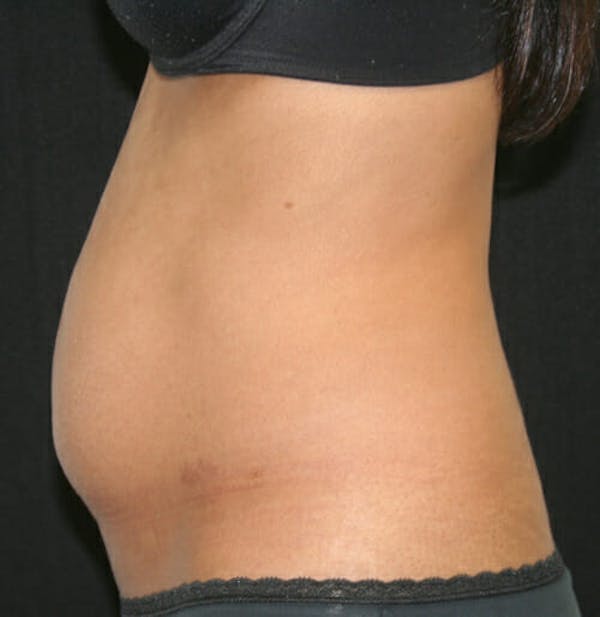 Tummy Tuck Gallery - Patient 9605578 - Image 5