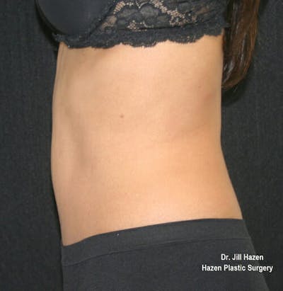 Tummy Tuck Before & After Gallery - Patient 9605578 - Image 6