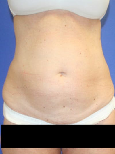 Tummy Tuck Before & After Gallery - Patient 9605579 - Image 1