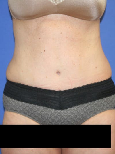 Tummy Tuck Before & After Gallery - Patient 9605579 - Image 2