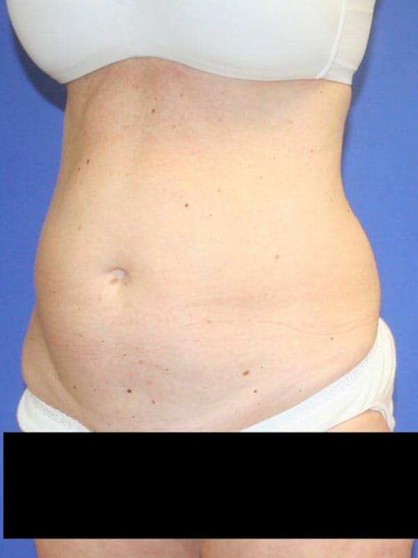 Tummy Tuck Before & After Gallery - Patient 9605579 - Image 3