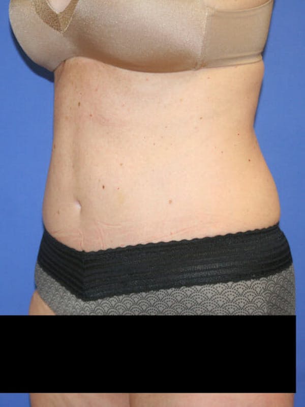 Tummy Tuck Before & After Gallery - Patient 9605579 - Image 4
