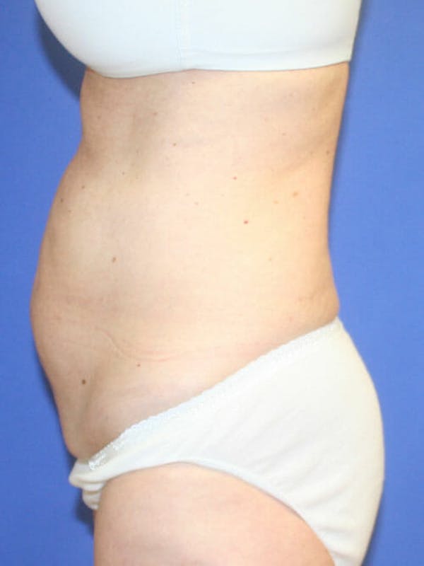 Tummy Tuck Before & After Gallery - Patient 9605579 - Image 5