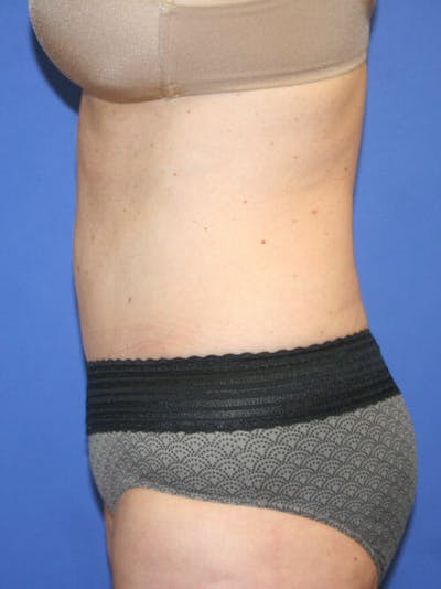 Tummy Tuck Before & After Gallery - Patient 9605579 - Image 6