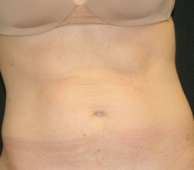 Tummy Tuck Before & After Gallery - Patient 9605580 - Image 1