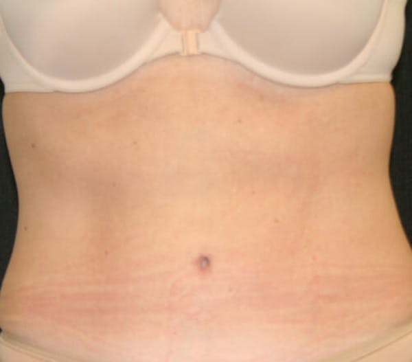 Tummy Tuck Before & After Gallery - Patient 9605580 - Image 2