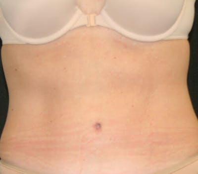 Tummy Tuck Before & After Gallery - Patient 9605580 - Image 2