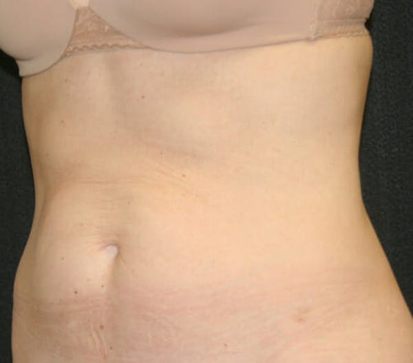 Tummy Tuck Before & After Gallery - Patient 9605580 - Image 3