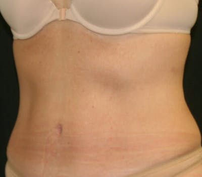 Tummy Tuck Before & After Gallery - Patient 9605580 - Image 4