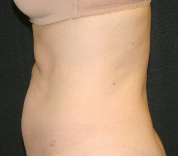 Tummy Tuck Before & After Gallery - Patient 9605580 - Image 5