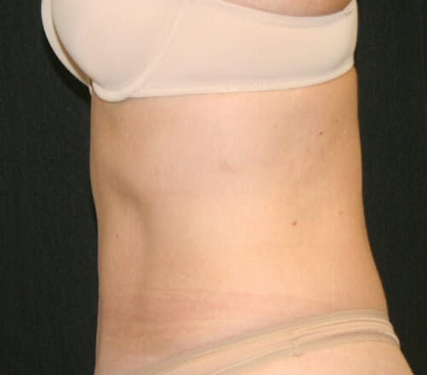 Tummy Tuck Before & After Gallery - Patient 9605580 - Image 6