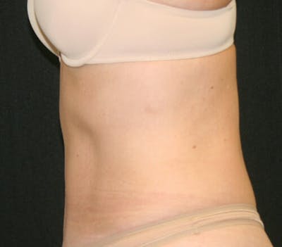 Tummy Tuck Before & After Gallery - Patient 9605580 - Image 6