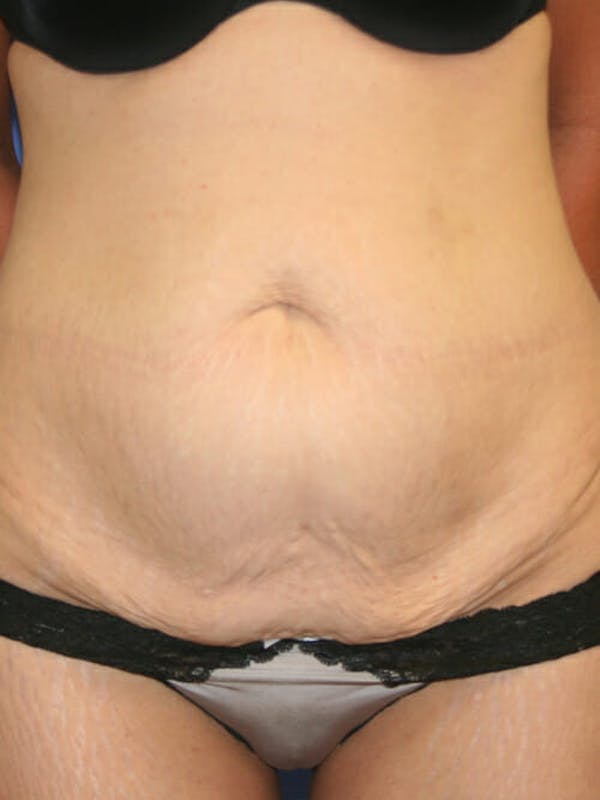Patient 9605581, Tummy Tuck Before & After Photos