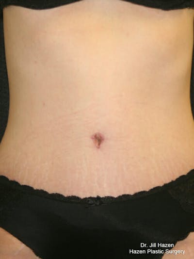 Tummy Tuck Before & After Gallery - Patient 9605581 - Image 2