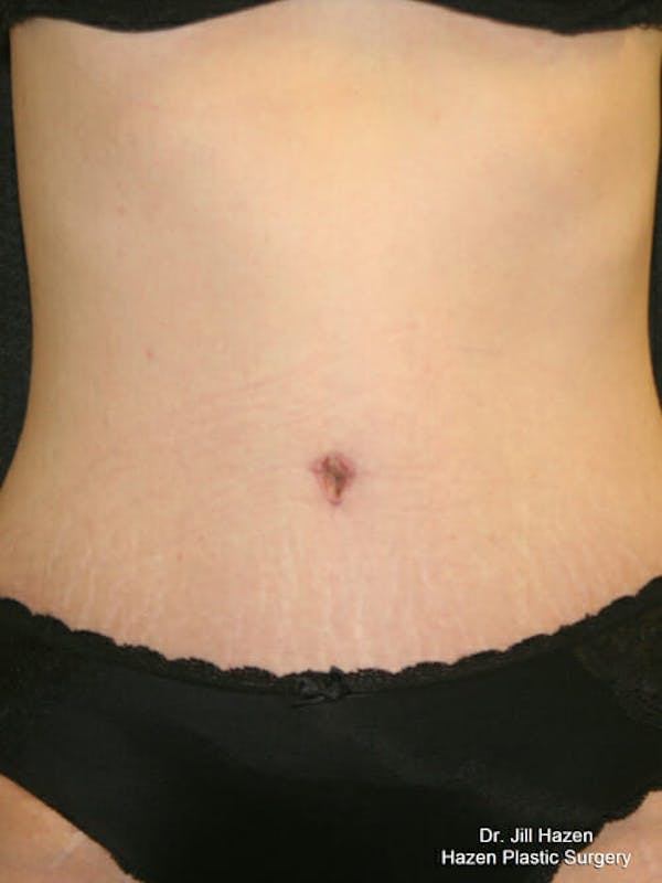Tummy Tuck Gallery - Patient 9605581 - Image 2