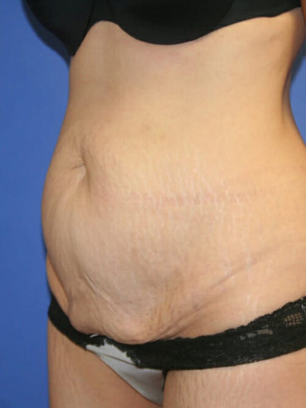 Tummy Tuck Gallery - Patient 9605581 - Image 3