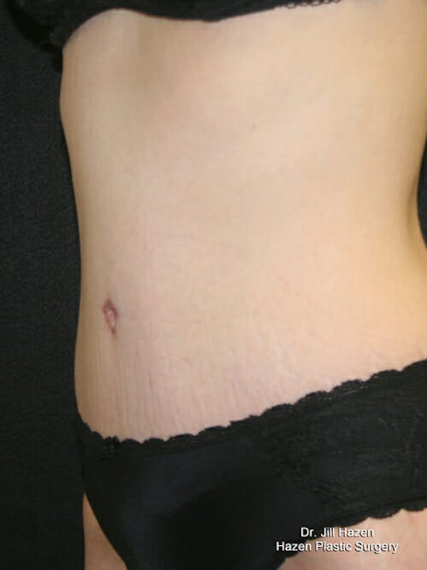 Tummy Tuck Gallery - Patient 9605581 - Image 4