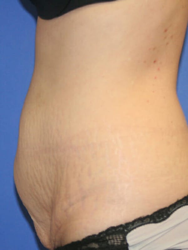 Tummy Tuck Before & After Gallery - Patient 9605581 - Image 5