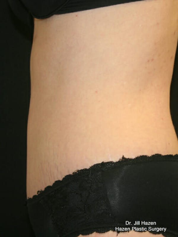 Tummy Tuck Before & After Gallery - Patient 9605581 - Image 6