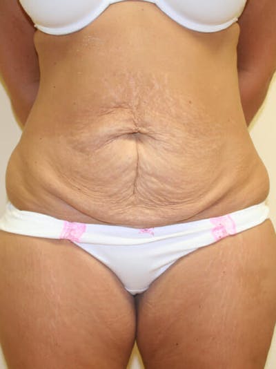 Tummy Tuck Before & After Gallery - Patient 9605583 - Image 1