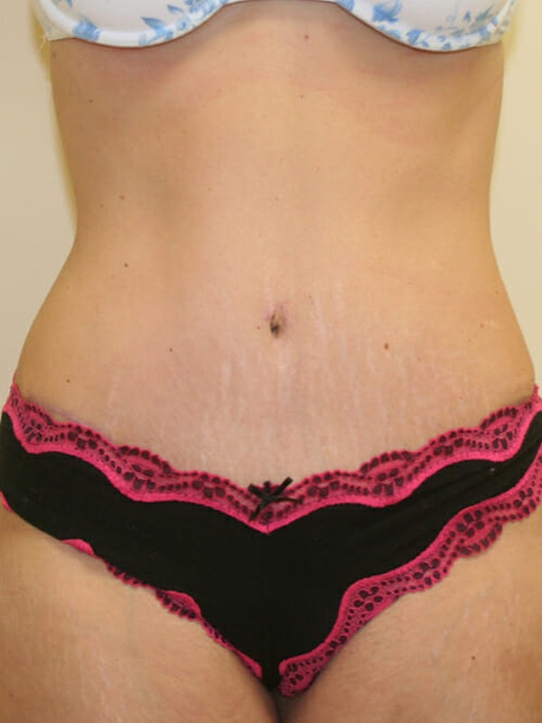 Tummy Tuck