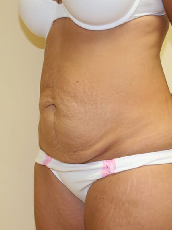 Tummy Tuck Before & After Gallery - Patient 9605583 - Image 3