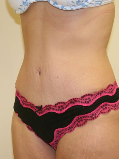 Tummy Tuck Before & After Gallery - Patient 9605583 - Image 4