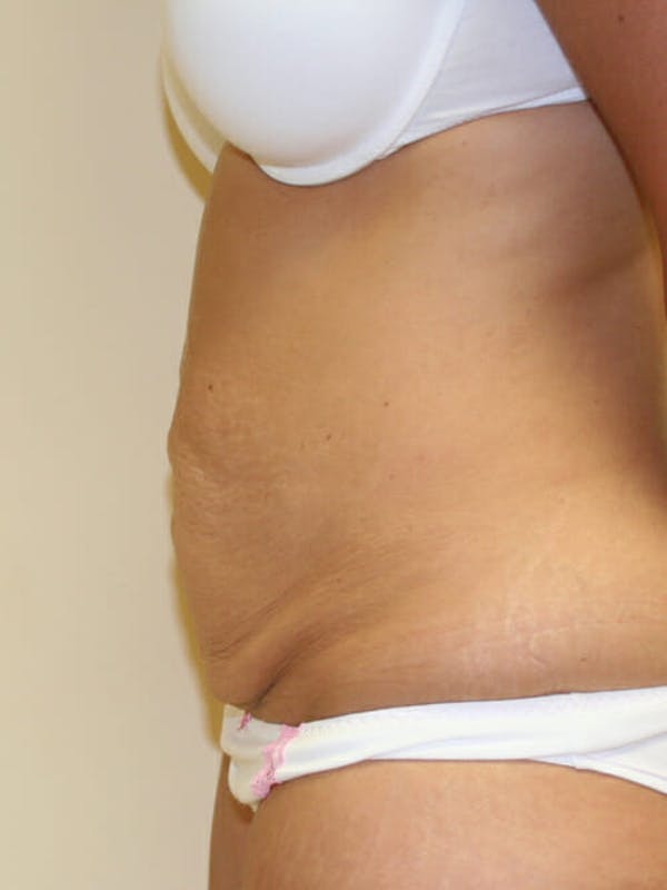 Tummy Tuck Before & After Gallery - Patient 9605583 - Image 5